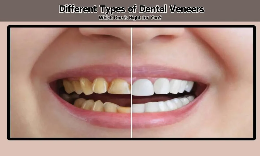 The Different Types Of Dental Veneers Which One Is Right For You