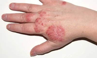 Eczema Explained: Signs, Symptoms, and Underlying Causes