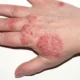 Eczema Explained: Signs, Symptoms, and Underlying Causes