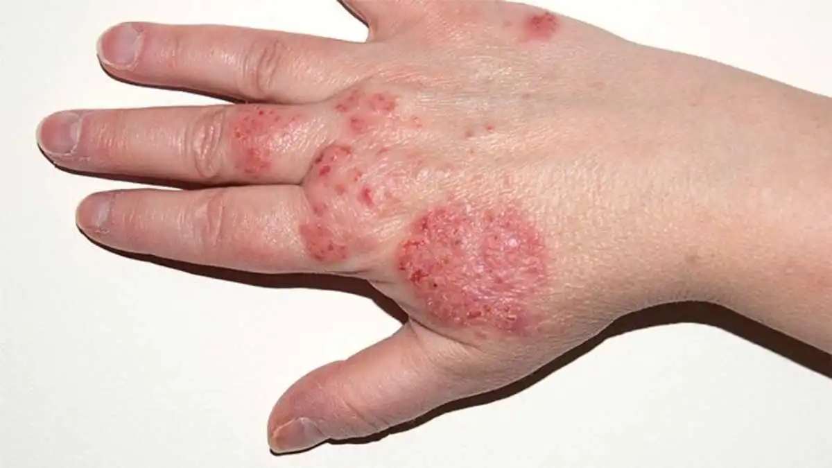 Eczema Explained: Signs, Symptoms, and Underlying Causes