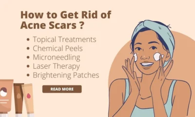 How to Get Rid of Acne Scars