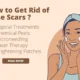 How to Get Rid of Acne Scars