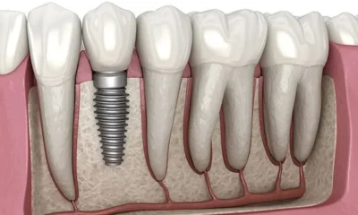 Dental Implants