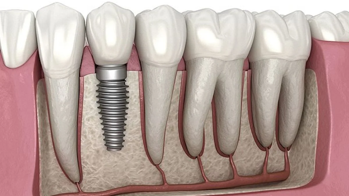 Dental Implants